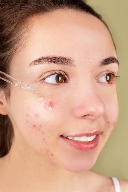 treating-acne