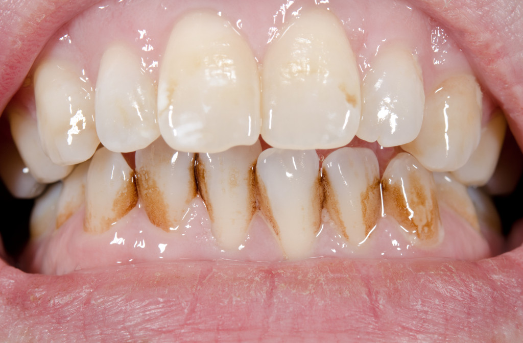 A close-up of brown teeth with dirt building up near the gums